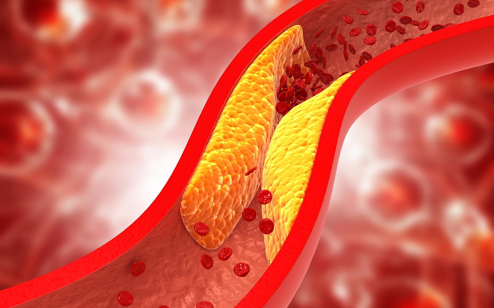 Arteriosklerose Symptome - Hauptursache der koronaren Herzkrankheit
