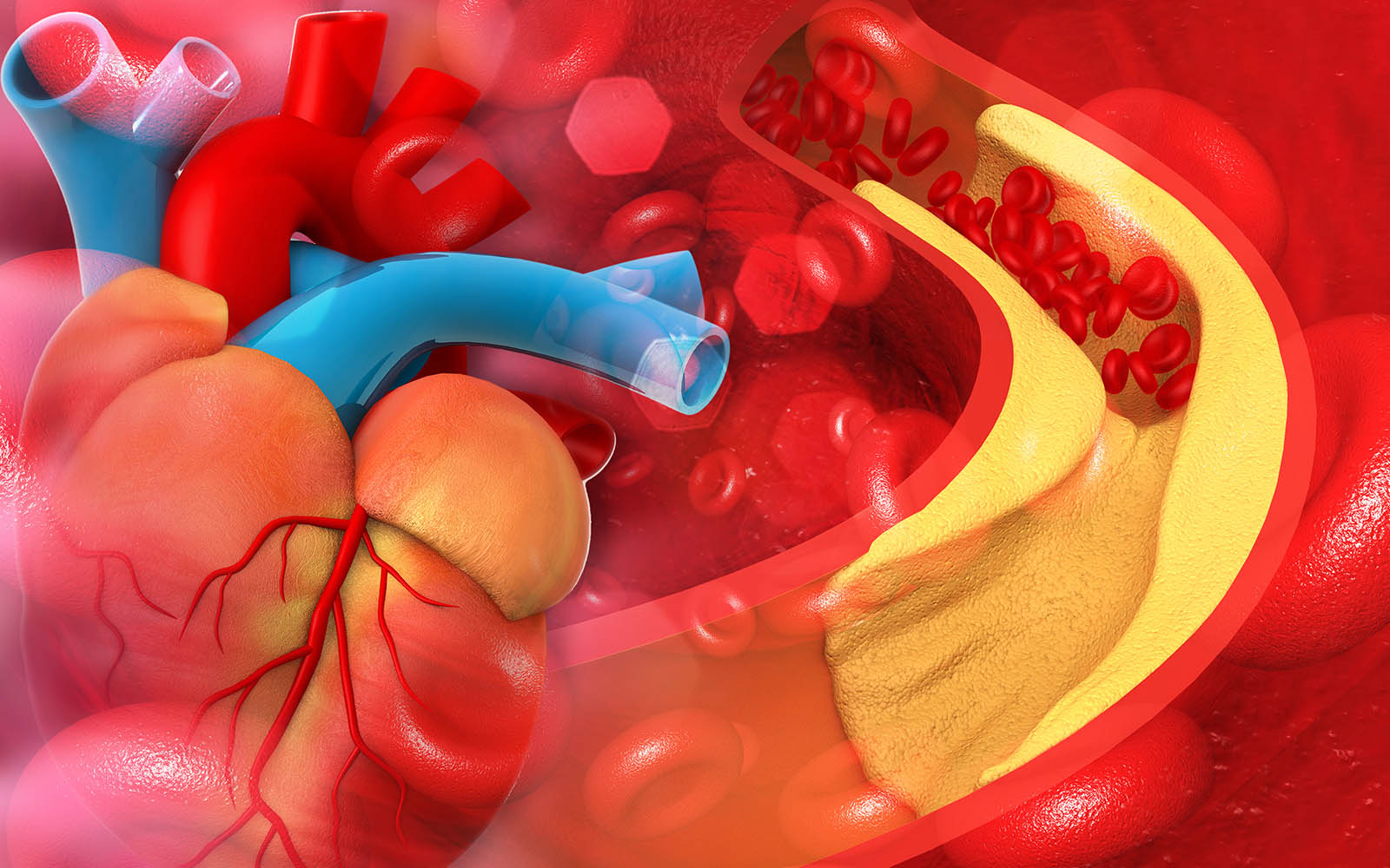 Koronare Herzkrankheit: Symptome, Ursachen, Behandlung