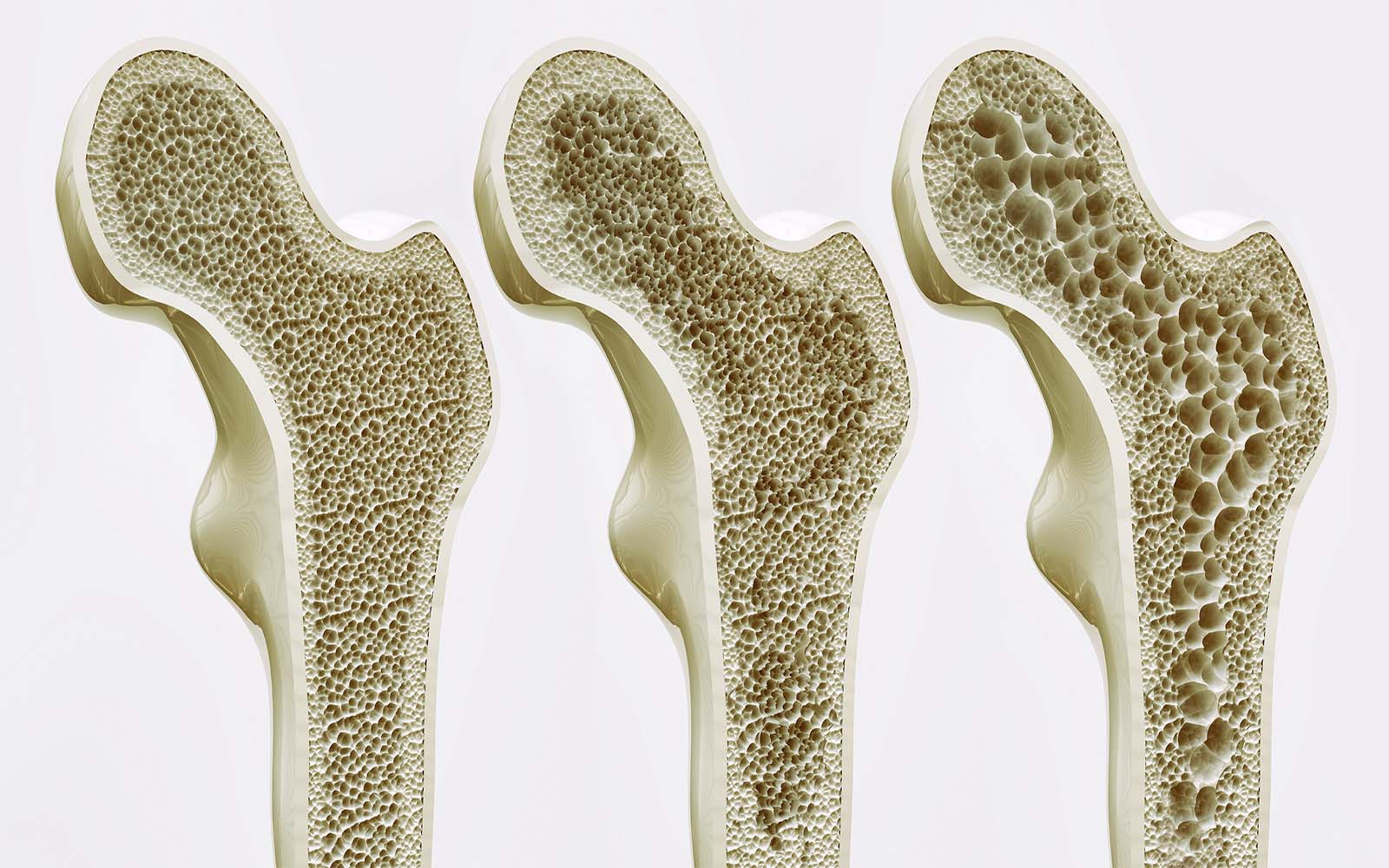 Osteoporose Ratgeber - Ursachen, Symptome, Behandlung