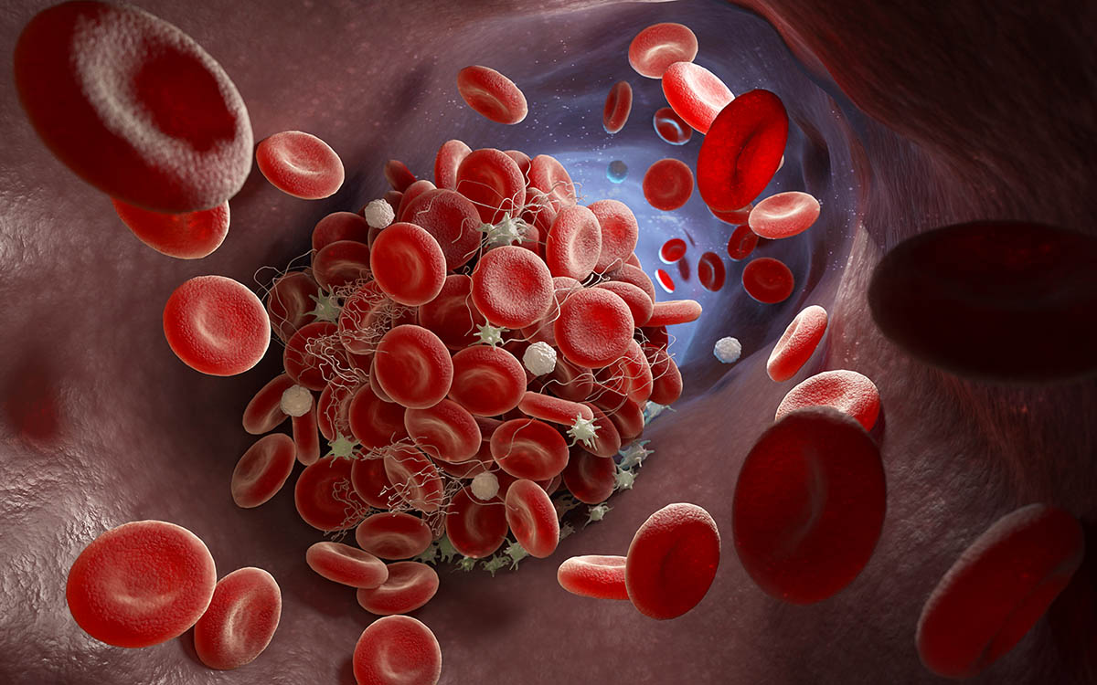 Thrombose: Symptome, Risikofaktoren und Behandlung verstehen